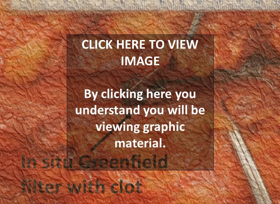 Greenfield filter with clot Autopsy Center of Chicago