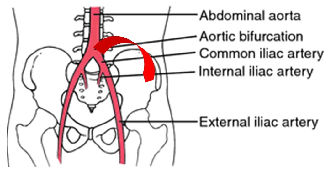 Monthly Case: Aortic Rupture | Autopsy Center of Chicago